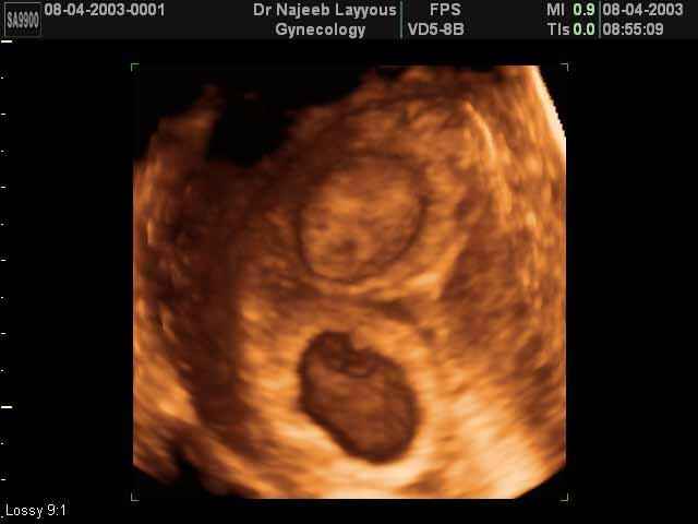 Seven Weeks Twins Pregnancy