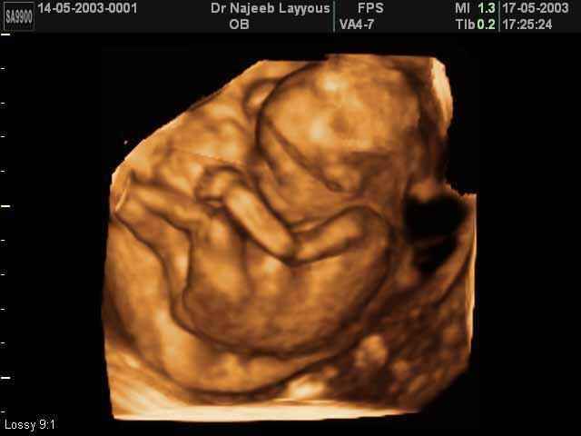 3D Second Trimester