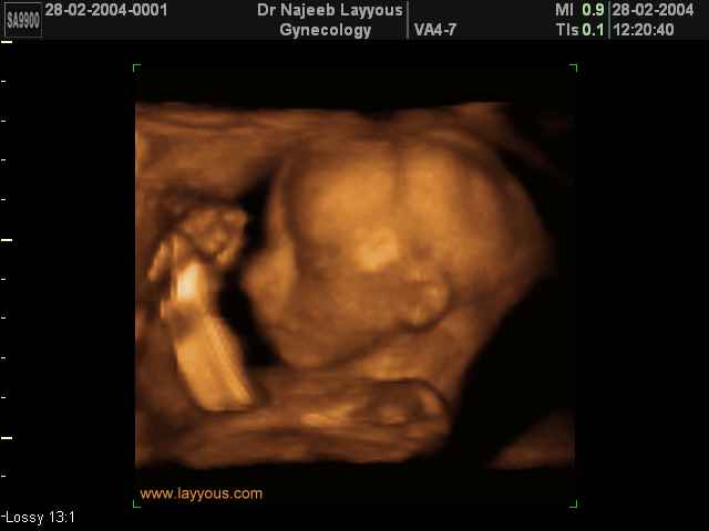 3D Second Trimester