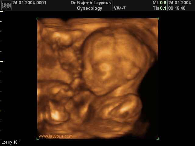 3D Second Trimester