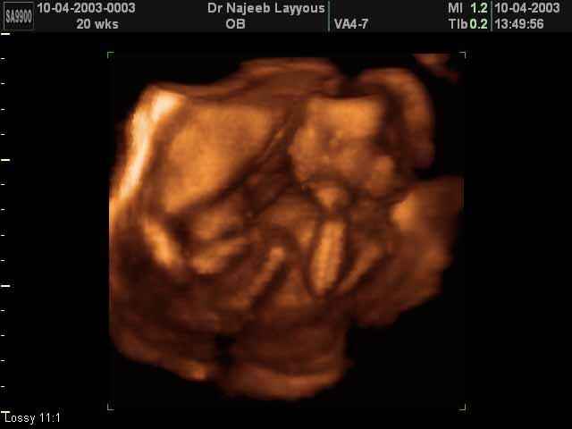 3D Second Trimester