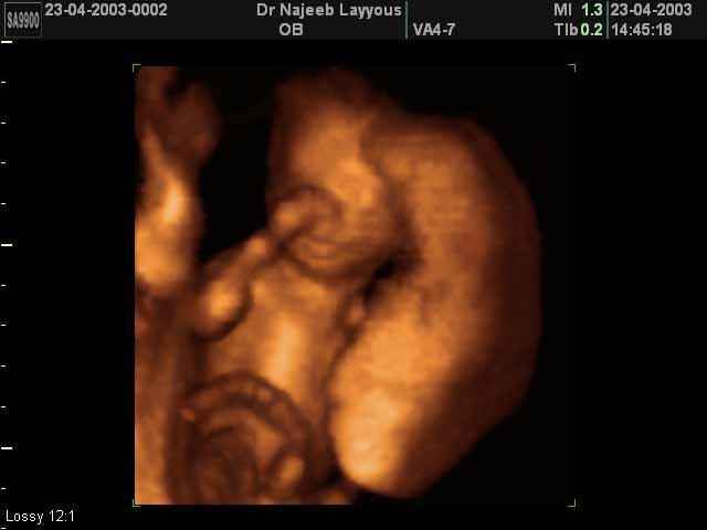 3D Second Trimester