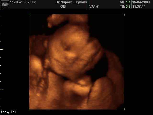 3D Second Trimester