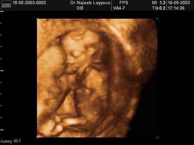 3D Second Trimester