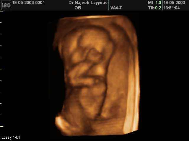 3D Second Trimester