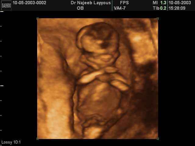 3D Second Trimester