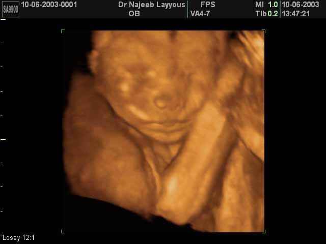 3D Second Trimester