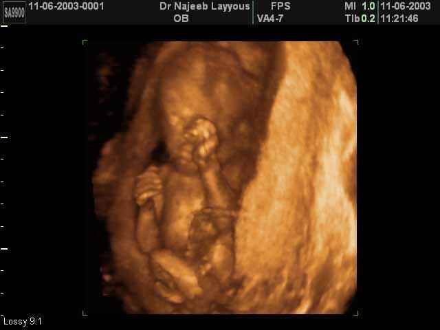 3D Second Trimester