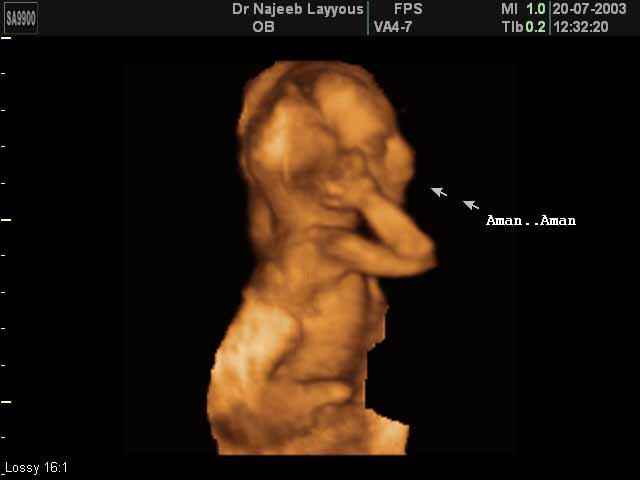 3D Second Trimester