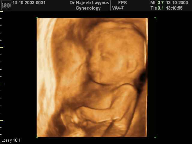 3D Second Trimester