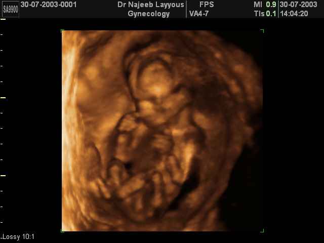 3D Second Trimester