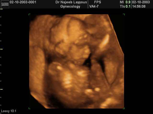 3D Second Trimester