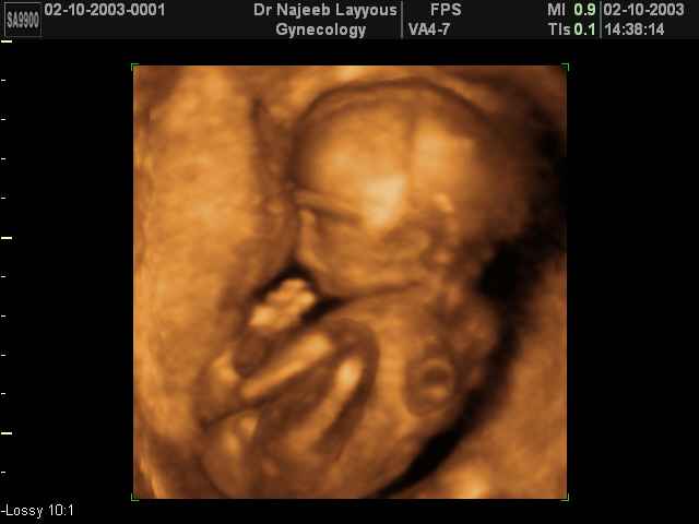 3D Second Trimester