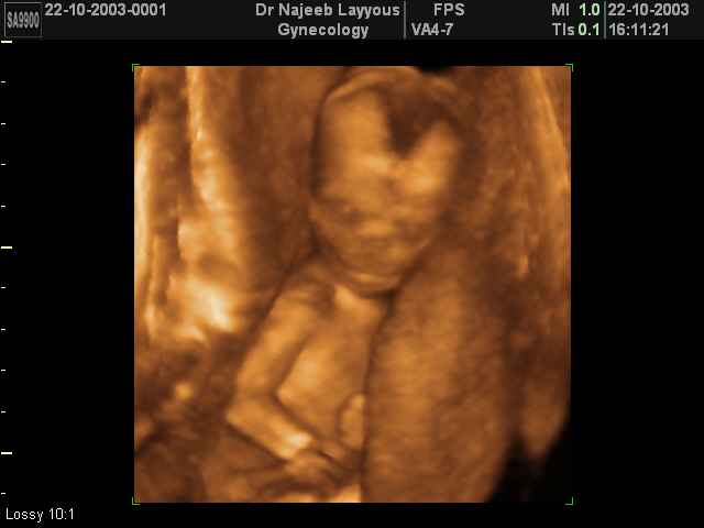 3D Second Trimester