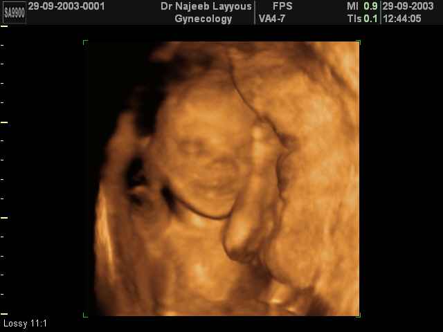 3D Second Trimester