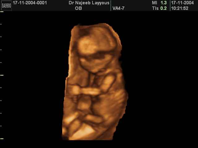 3D Second Trimester