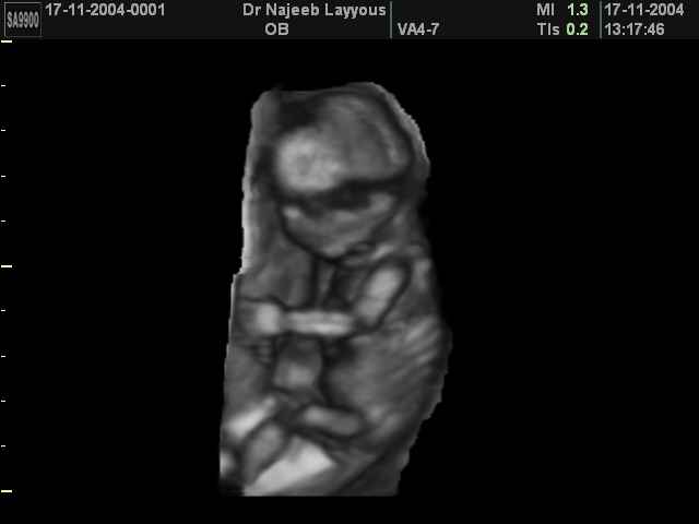 3D Second Trimester