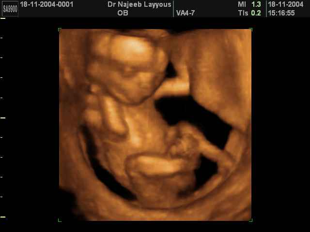 3D Second Trimester