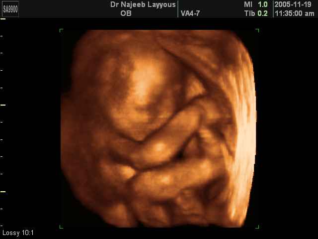 3D Second Trimester