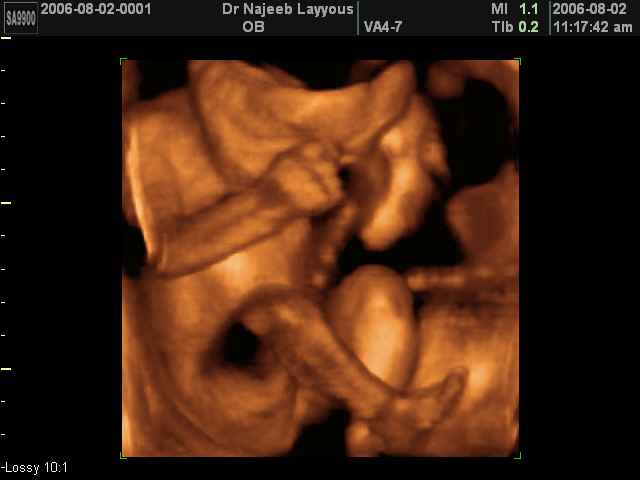 3D Second Trimester