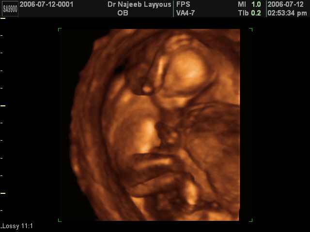 3D Second Trimester