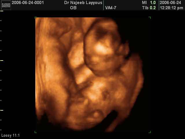 3D Second Trimester